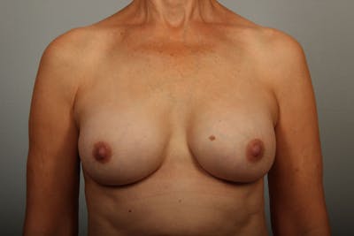 Breast Implant Correction Before & After Gallery - Patient 284741 - Image 2