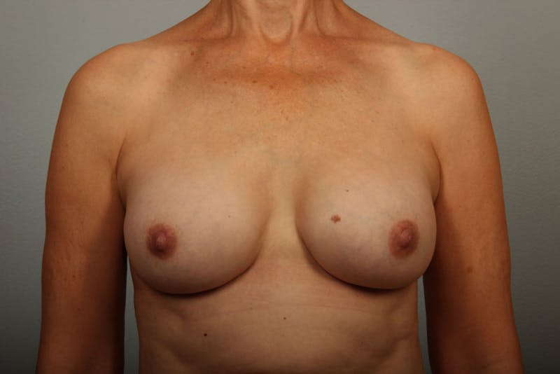Breast Implant Correction Before & After Gallery - Patient 284741 - Image 2