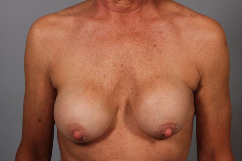 Breast Implant Correction Before & After Gallery - Patient 402538 - Image 1