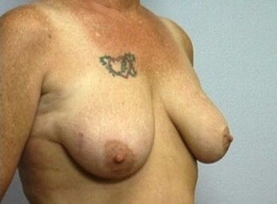 Breast Lift Before & After Gallery - Patient 115012 - Image 1