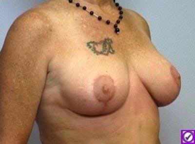 Breast Lift Before & After Gallery - Patient 115012 - Image 2