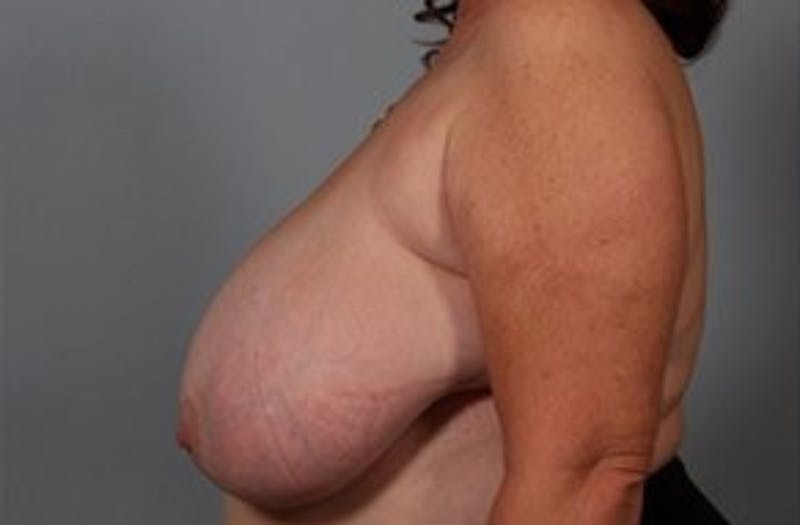Breast Reshaping and Reduction Before & After Gallery - Patient 160934 - Image 1