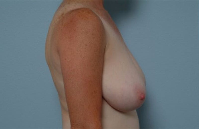 Breast Reshaping and Reduction Before & After Gallery - Patient 384954 - Image 1