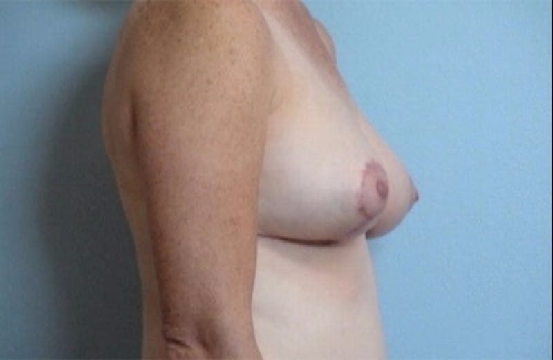 Breast Reshaping and Reduction Before & After Gallery - Patient 384954 - Image 2