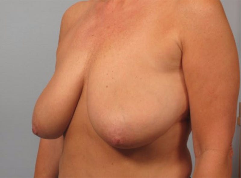 Breast Reshaping and Reduction Before & After Gallery - Patient 267485 - Image 1