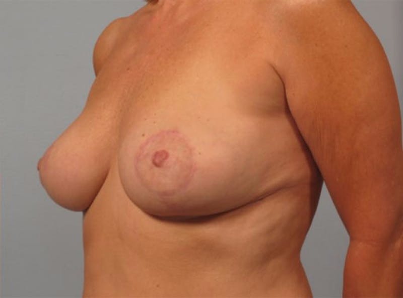 Breast Reshaping and Reduction Before & After Gallery - Patient 267485 - Image 2