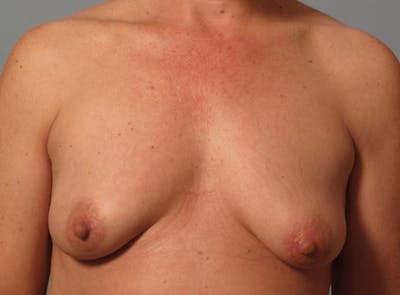 PerkyLift Before & After Gallery - Patient 758863 - Image 1