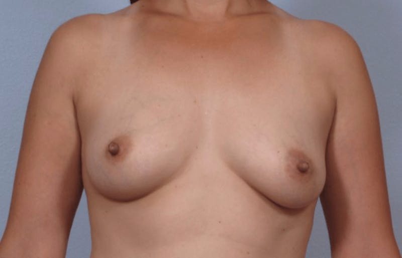 PerkyLift Before & After Gallery - Patient 159793 - Image 1