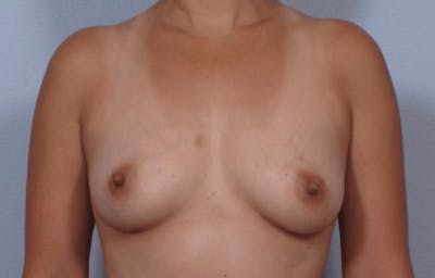 PerkyLift Before & After Gallery - Patient 159793 - Image 2