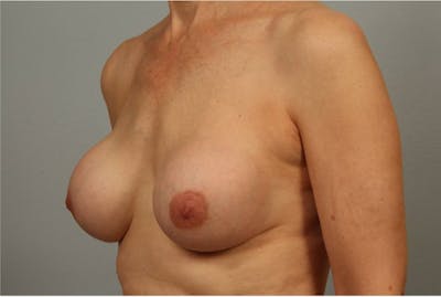 PerkyLift Before & After Gallery - Patient 119153 - Image 1