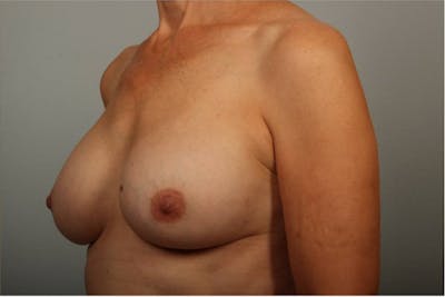 PerkyLift Before & After Gallery - Patient 119153 - Image 2