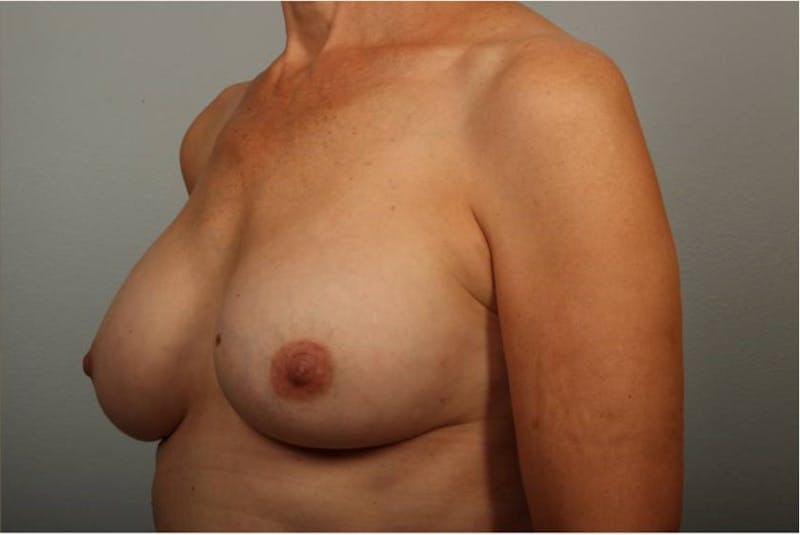PerkyLift Before & After Gallery - Patient 119153 - Image 2