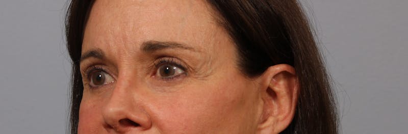Brow Lift Before & After Gallery - Patient 260671 - Image 1