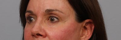 Brow Lift Before & After Gallery - Patient 260671 - Image 2