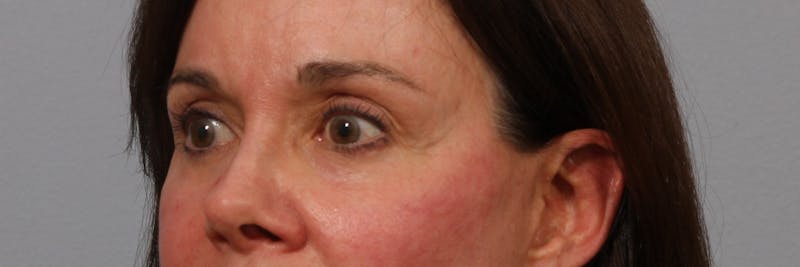 Brow Lift Before & After Gallery - Patient 260671 - Image 2