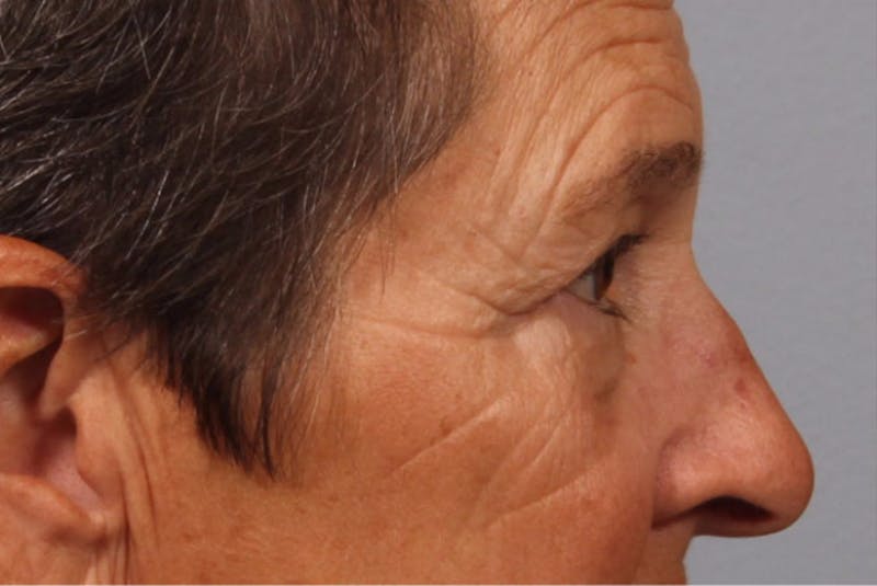 Brow Lift Before & After Gallery - Patient 403653 - Image 1