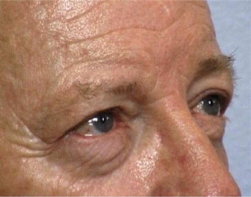 Brow Lift Before & After Gallery - Patient 103807 - Image 1