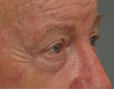 Brow Lift Before & After Gallery - Patient 103807 - Image 2