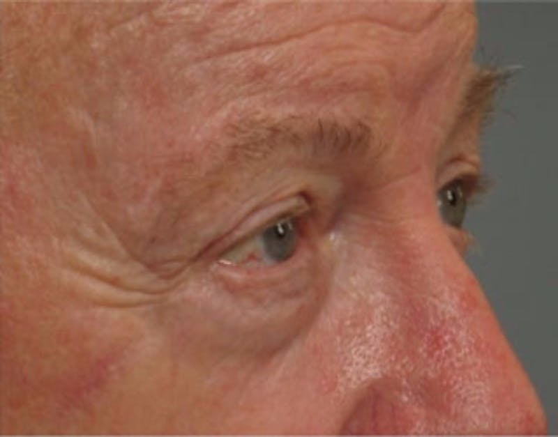 Brow Lift Before & After Gallery - Patient 103807 - Image 2