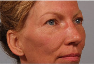 Brow Lift Before & After Gallery - Patient 266911 - Image 1