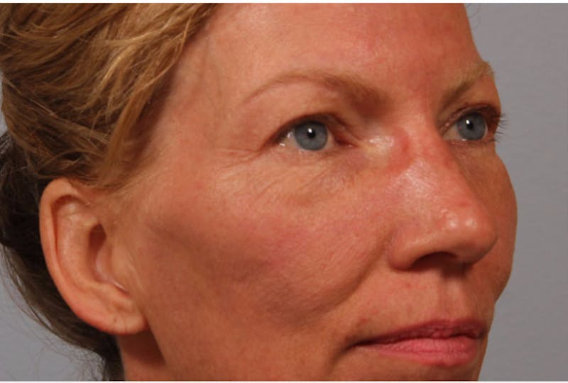 Eyelid Surgery Before & After Gallery - Patient 672131 - Image 1