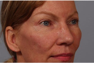 Brow Lift Before & After Gallery - Patient 266911 - Image 2