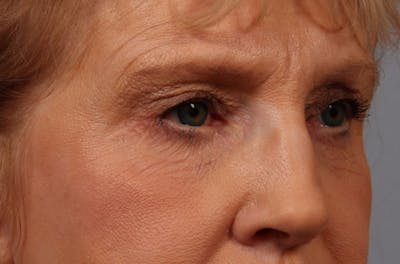 Brow Lift Before & After Gallery - Patient 329277 - Image 1