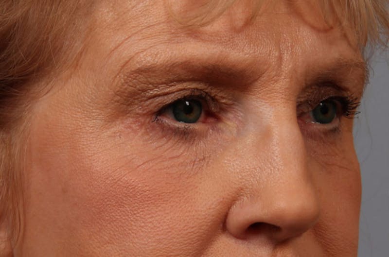 Eyelid Surgery Before & After Gallery - Patient 264825 - Image 1