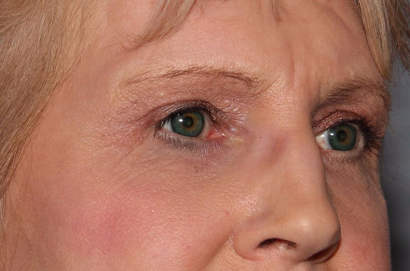 Eyelid Surgery Before & After Gallery - Patient 264825 - Image 2