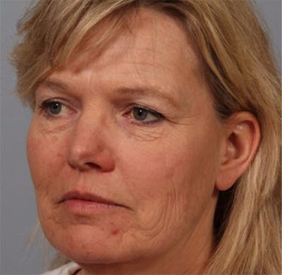 Laser Resurfacing Before & After Gallery - Patient 102751 - Image 1