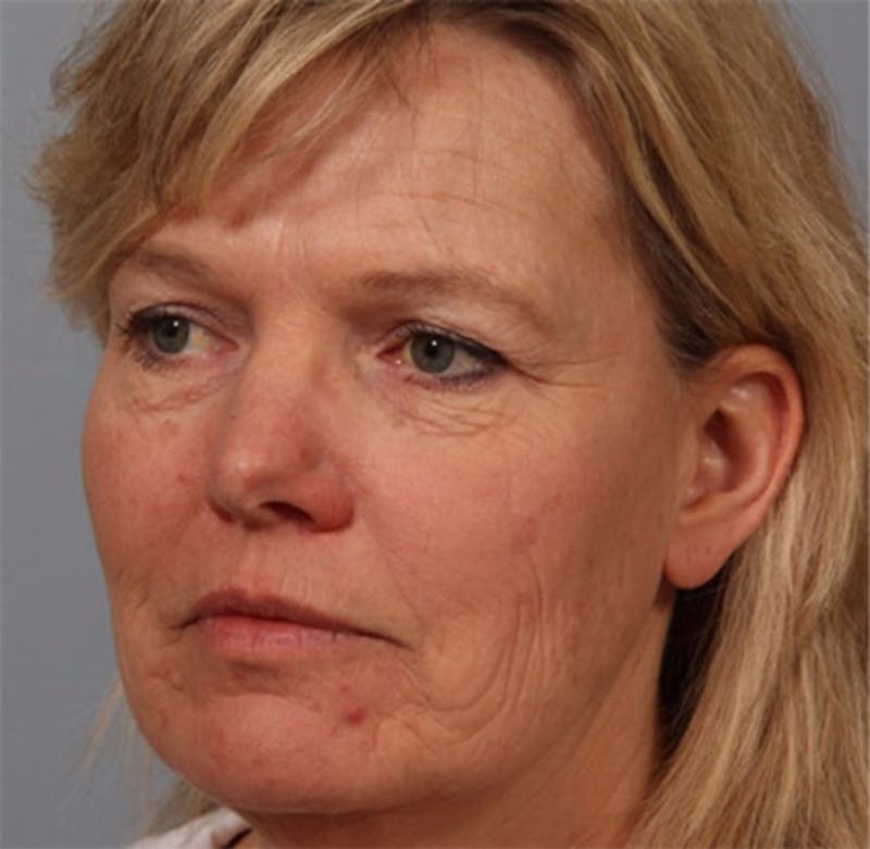 Brow Lift Before & After Gallery - Patient 229616 - Image 1