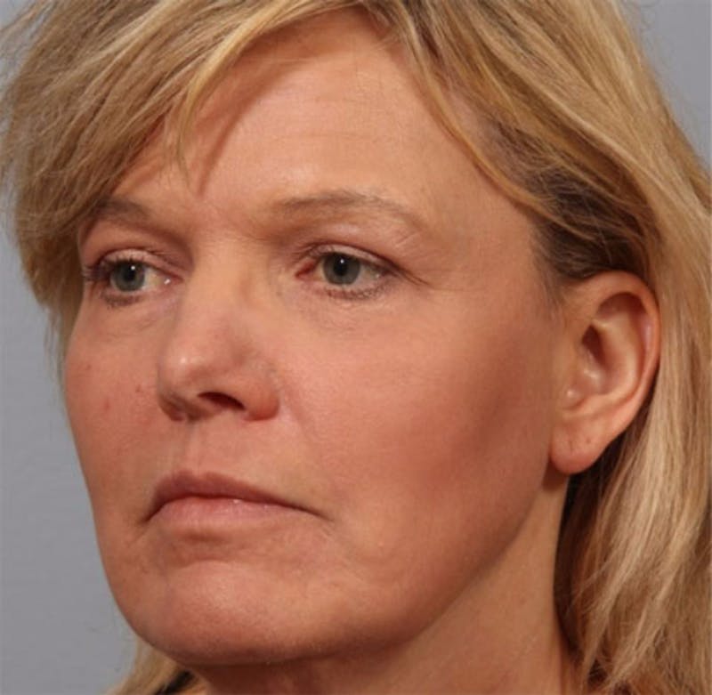 Brow Lift Before & After Gallery - Patient 229616 - Image 2