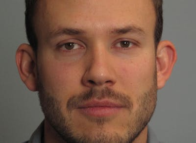 Ear Surgery Before & After Gallery - Patient 214673 - Image 1