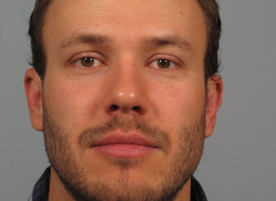 Ear Surgery Before & After Gallery - Patient 214673 - Image 2