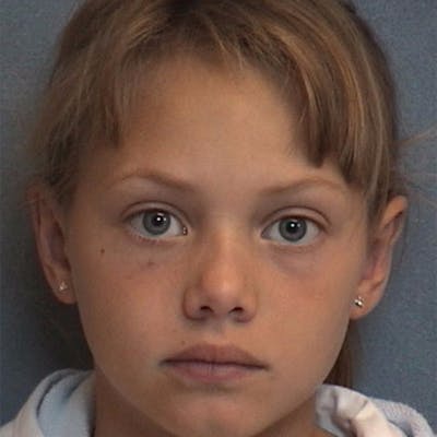 Ear Surgery Before & After Gallery - Patient 102394 - Image 2