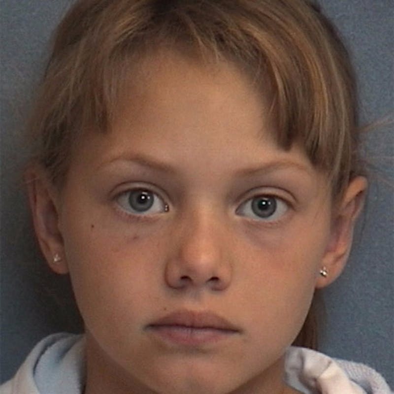 Ear Surgery Before & After Gallery - Patient 102394 - Image 2