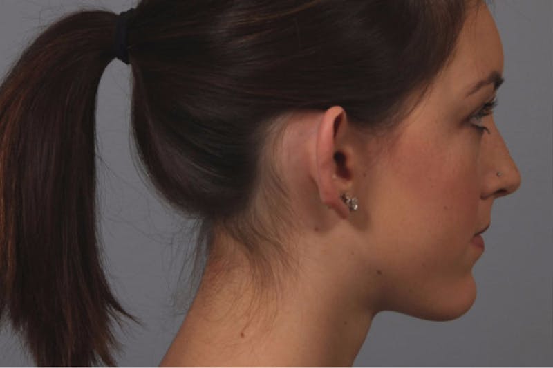 Ear Surgery Before & After Gallery - Patient 733696 - Image 1
