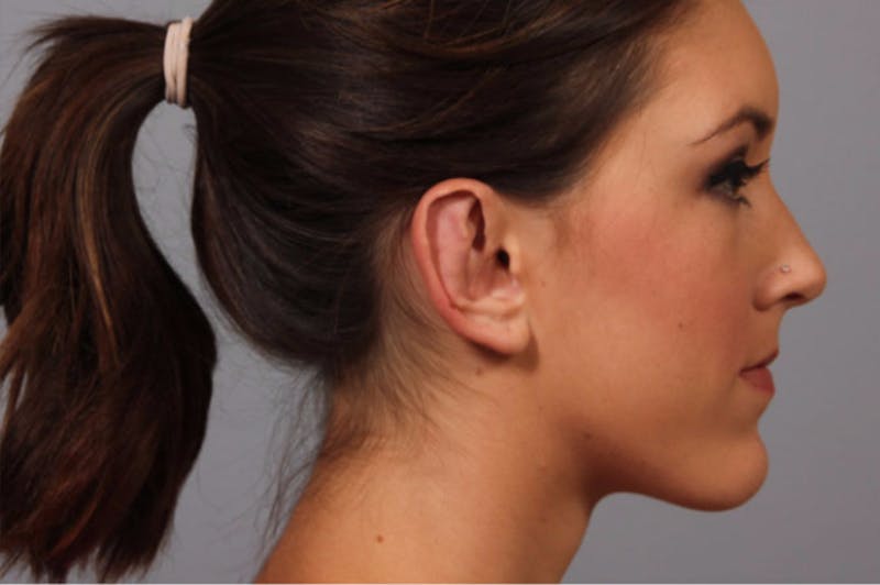 Ear Surgery Before & After Gallery - Patient 733696 - Image 2