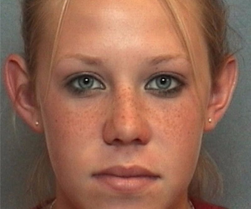 Ear Surgery Before & After Gallery - Patient 394941 - Image 1