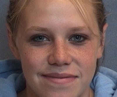 Ear Surgery Before & After Gallery - Patient 394941 - Image 2