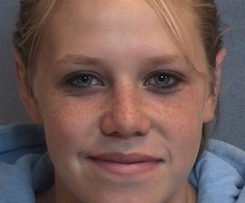 Ear Surgery Before & After Gallery - Patient 394941 - Image 2