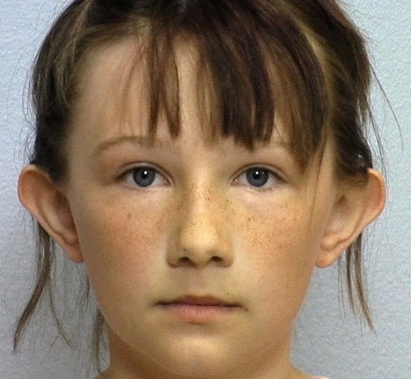 Ear Surgery Before & After Gallery - Patient 427327 - Image 1