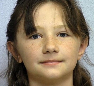 Ear Surgery Before & After Gallery - Patient 427327 - Image 2