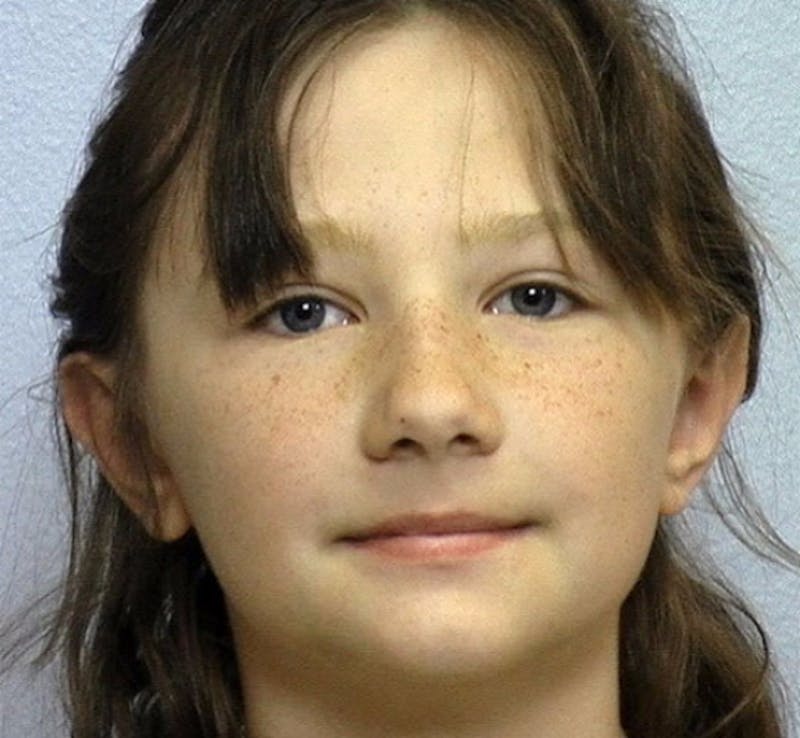 Ear Surgery Before & After Gallery - Patient 427327 - Image 2