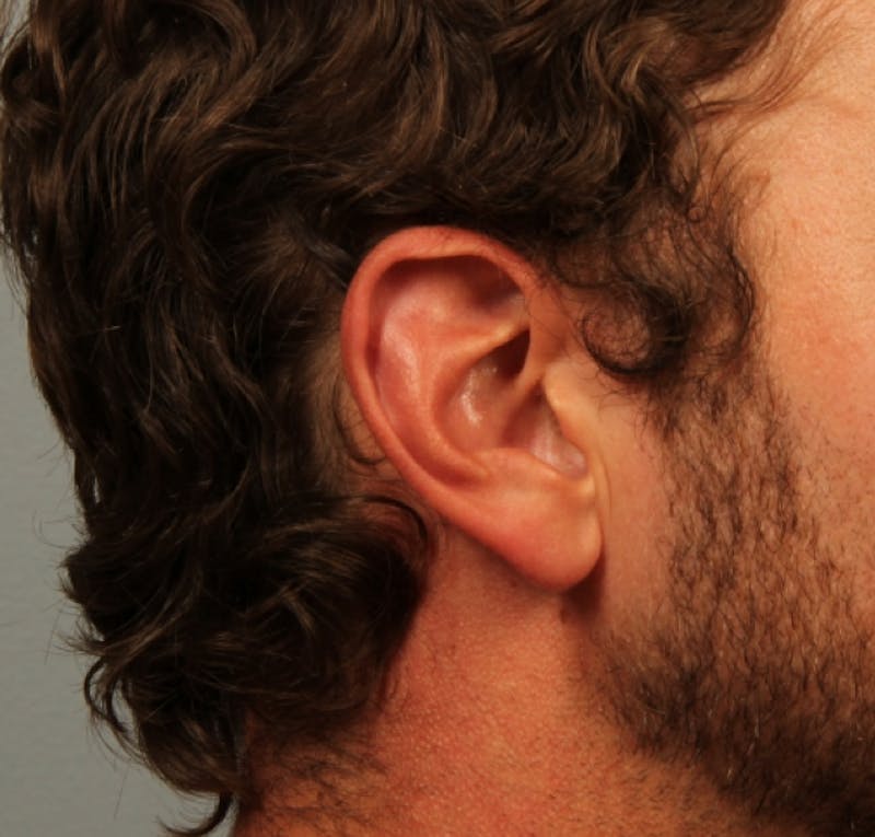 Ear Surgery Before & After Gallery - Patient 254575 - Image 1