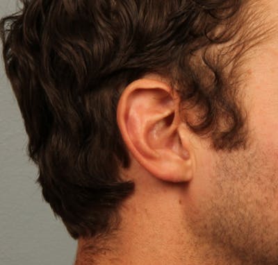 Ear Surgery Before & After Gallery - Patient 254575 - Image 2