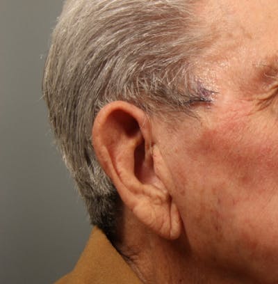 Ear Surgery Before & After Gallery - Patient 131876 - Image 1