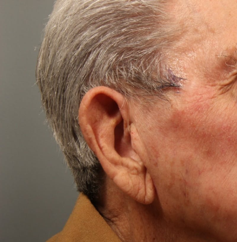 Ear Surgery Before & After Gallery - Patient 131876 - Image 1