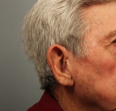 Ear Surgery Before & After Gallery - Patient 131876 - Image 2