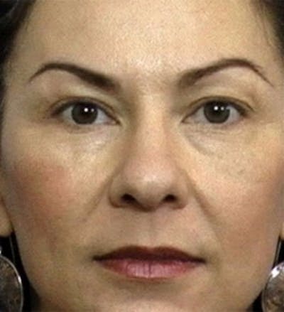 Eyelid Surgery Before & After Gallery - Patient 136520 - Image 1